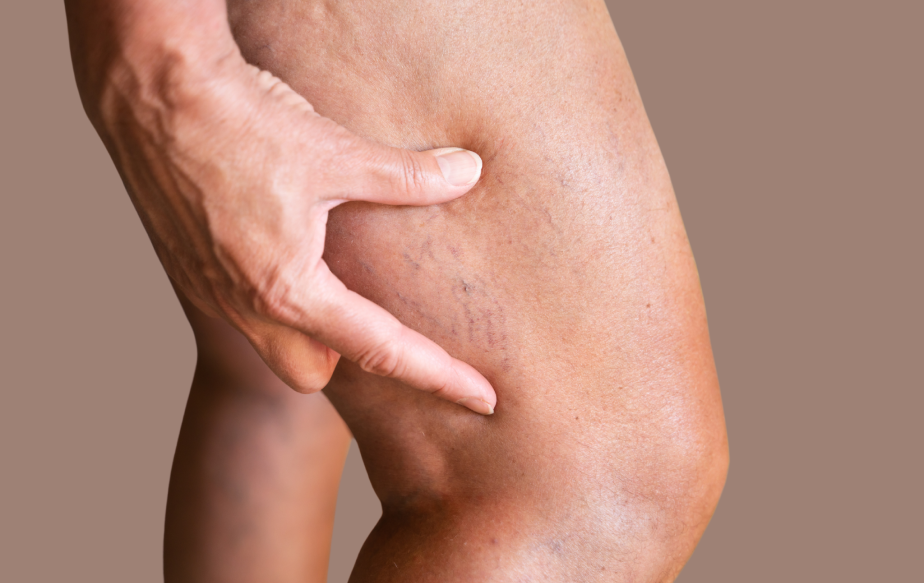 Varices et jambes lourdes : symptômes et traitement efficace
