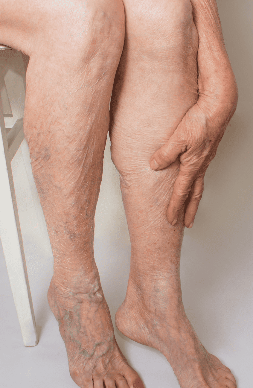 varices 1 15 Une femme âgée a des varices et des varicosités sur ses jambes