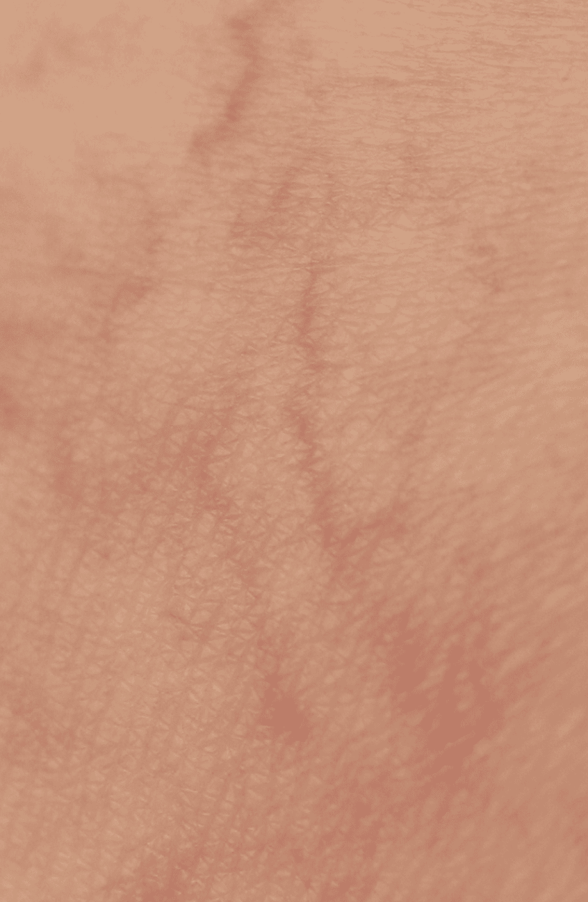 Varices Pelviennes 1 1 Zoom sur des veines apparentes au niveau de la zone du pelvis